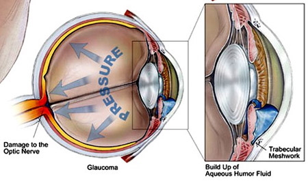insorgenza del glaucoma e misurazione della pressione intraoculare