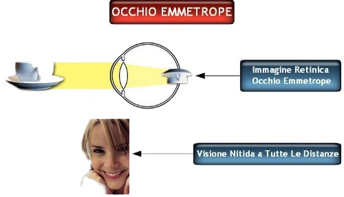 l'occhio emmetrope è in grado di vedere bene a tutte le distanze senza occhiali. Arena Ottici Optometristi Torino