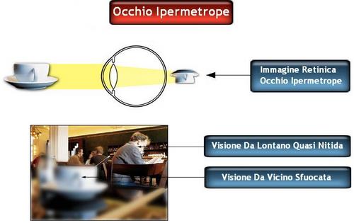 L'occhio ipermetrope ha problemi a mettere a fuoco da vicino e alle medie distanze. Arena Ottici Optometristi Torino