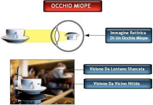 L'occhio miope ha problemi con la visione da lontano. Arena Ottici Optometristi Torino