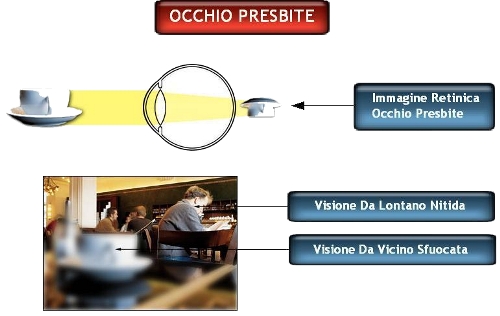 La presbiopia non permette una nitida visione da vicino