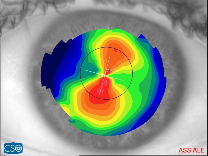 Topografia occhio astigmatico. Arena Ottici Optometristi Torino